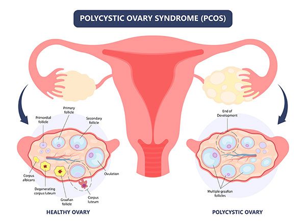 Polycystic Ovarian Syndrome (PCOS)