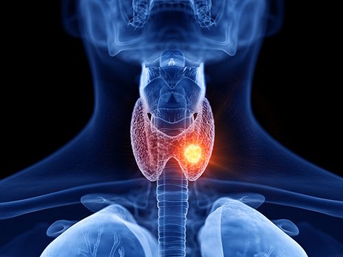 thyroid disorders